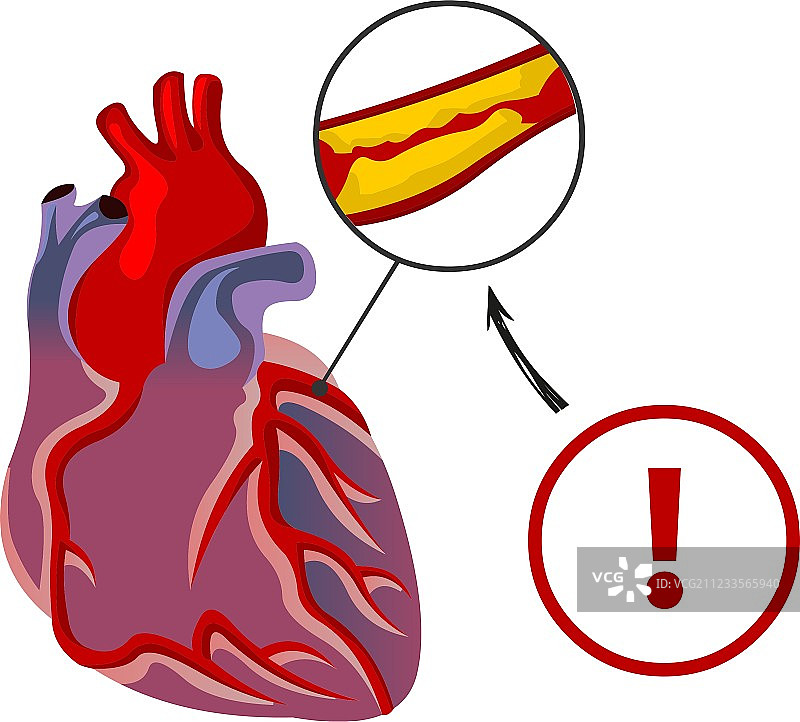 心脏衰竭的风险图片素材