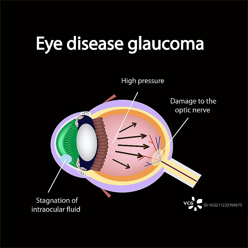 青光眼眼部病变图片素材