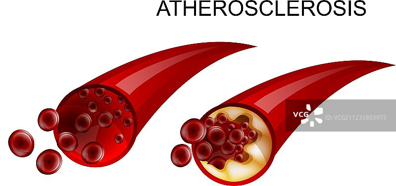 健康的血管和动脉粥样硬化图片素材