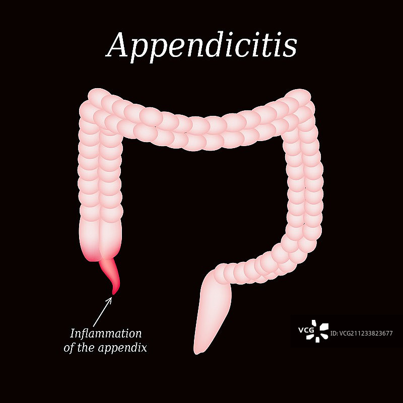 阑尾炎：阑尾结肠炎症图片素材
