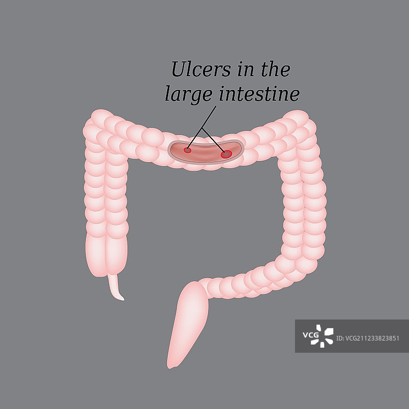 肠道溃疡和结肠溃疡图片素材