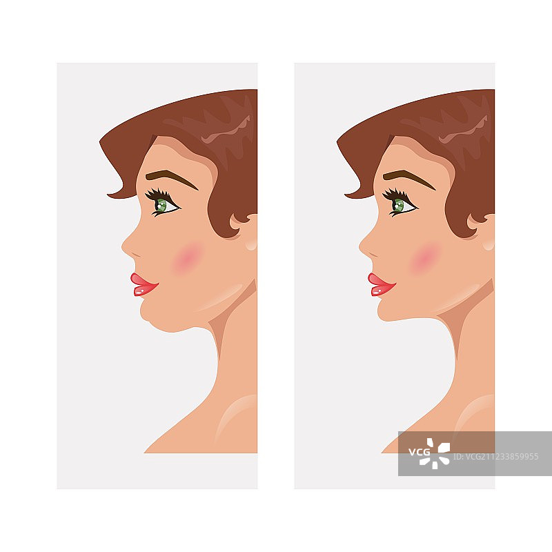 下巴整形前后对比图片素材