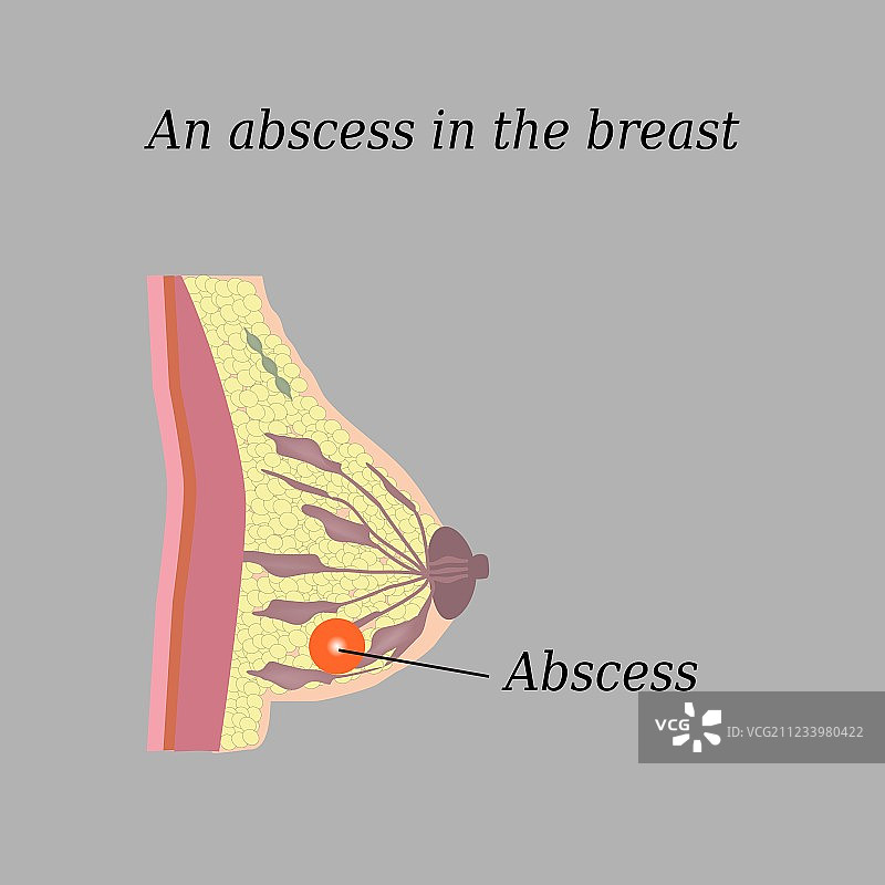 灰色背景上的胸部脓肿图片素材