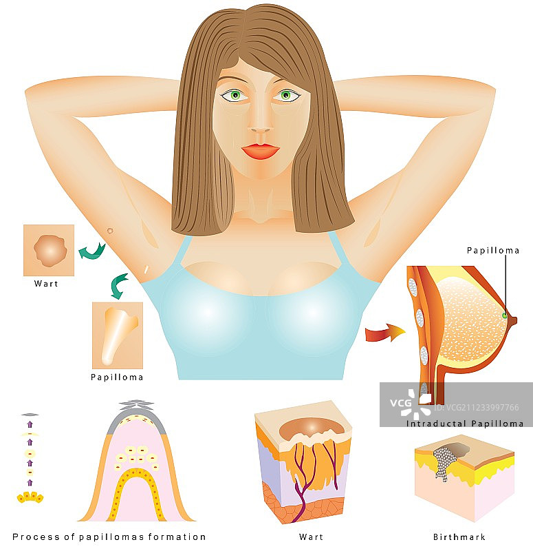 乳头状瘤图片素材