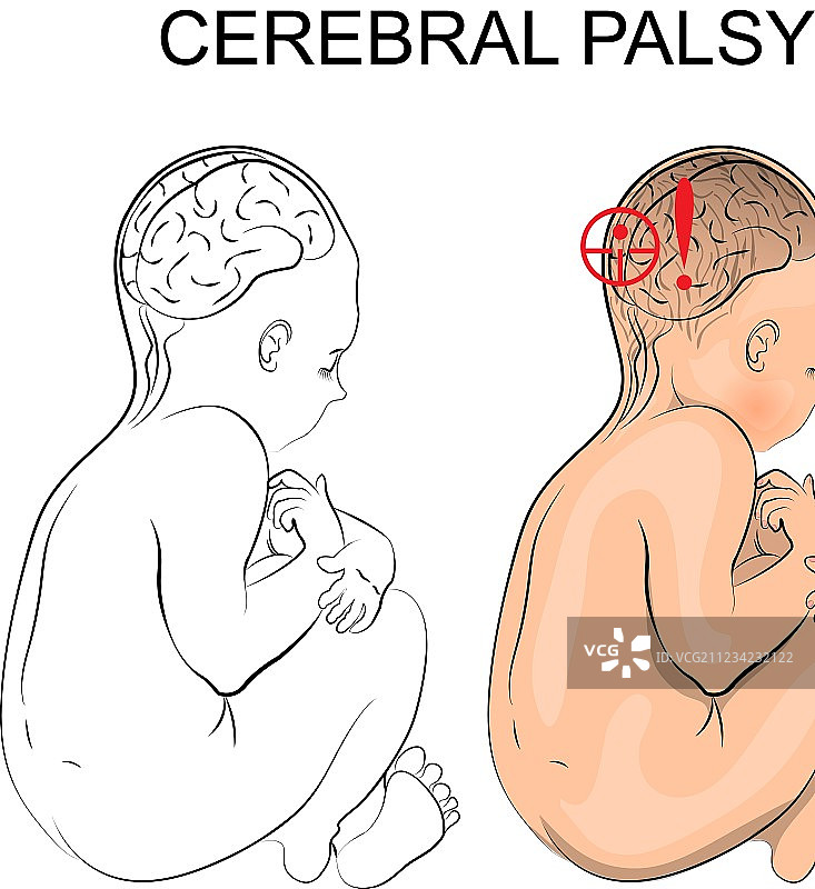 脑瘫神经内科图片素材