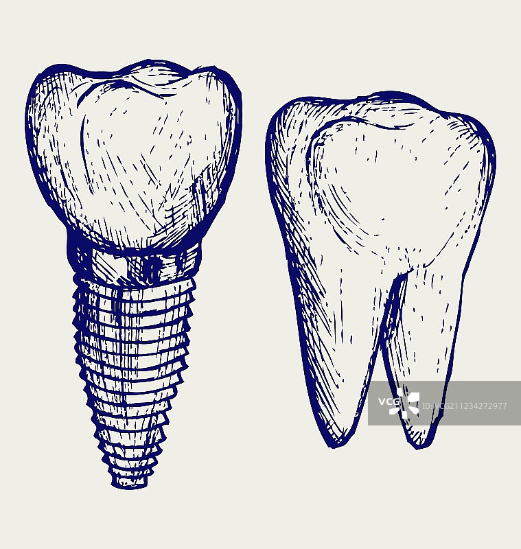 牙齿种植体和臼齿图片素材