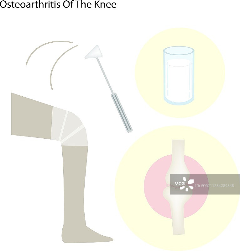 膝关节骨关节炎图图片素材