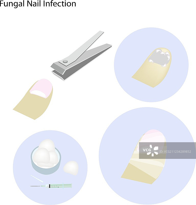 甲癣护理图片素材