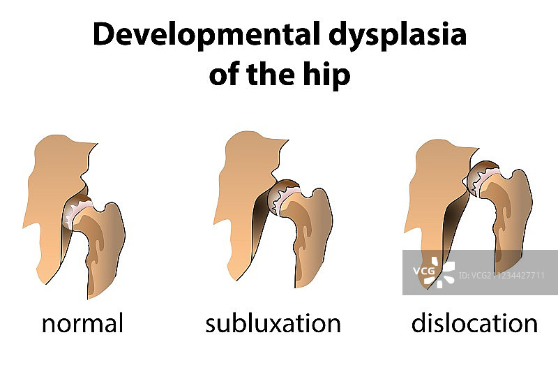 髋关节发育不良图片素材