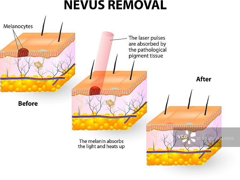 去除痣图片素材