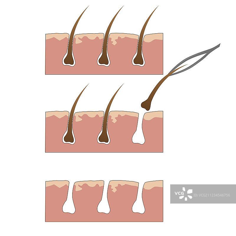 镊子皮肤脱毛示例图片素材