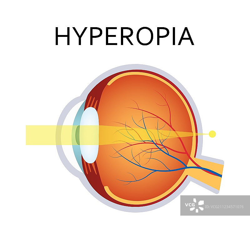 远视眼视力障碍图片素材