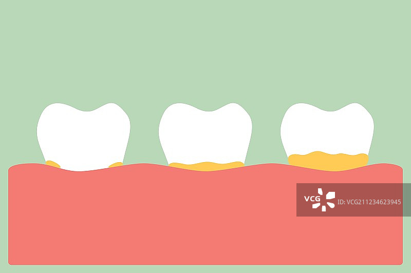 带有牙菌斑或牙垢的牙周疾病图片素材