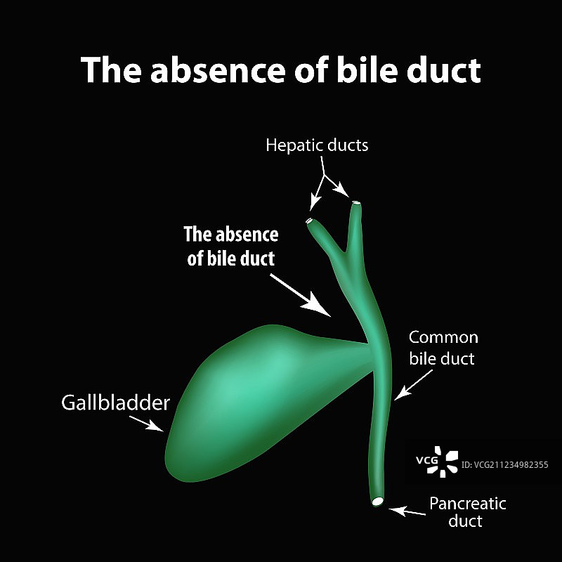 胆管病理学缺失图片素材