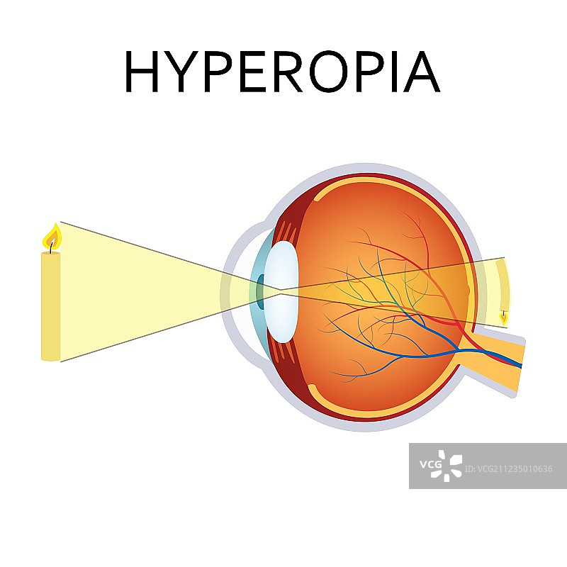 远视眼视力障碍图片素材