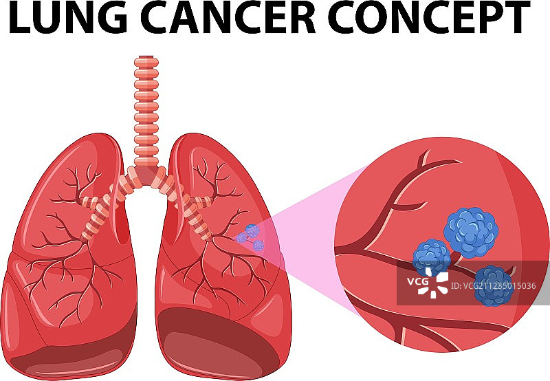 肺癌概念图解图片素材