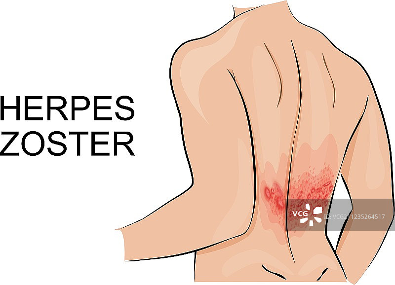 人类感染带状疱疹图片素材