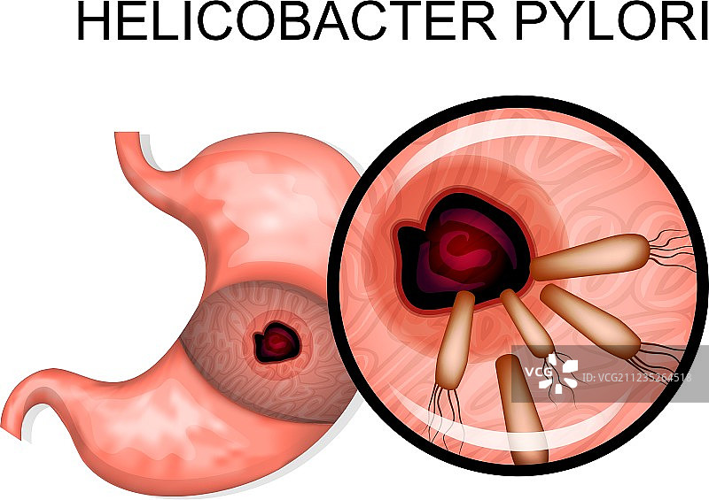 幽门螺杆菌引起的胃部病变图片素材