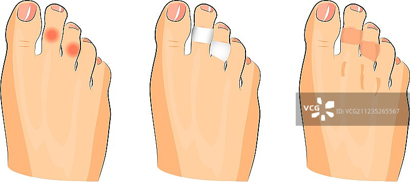 脚趾上的鸡眼图片素材