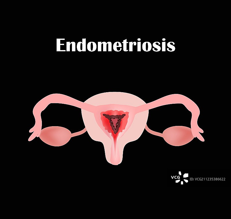 子宫内膜异位症盆腔器官结构图片素材