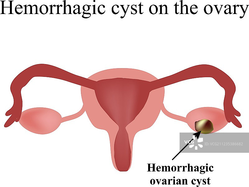 卵巢出血性囊肿信息图图片素材