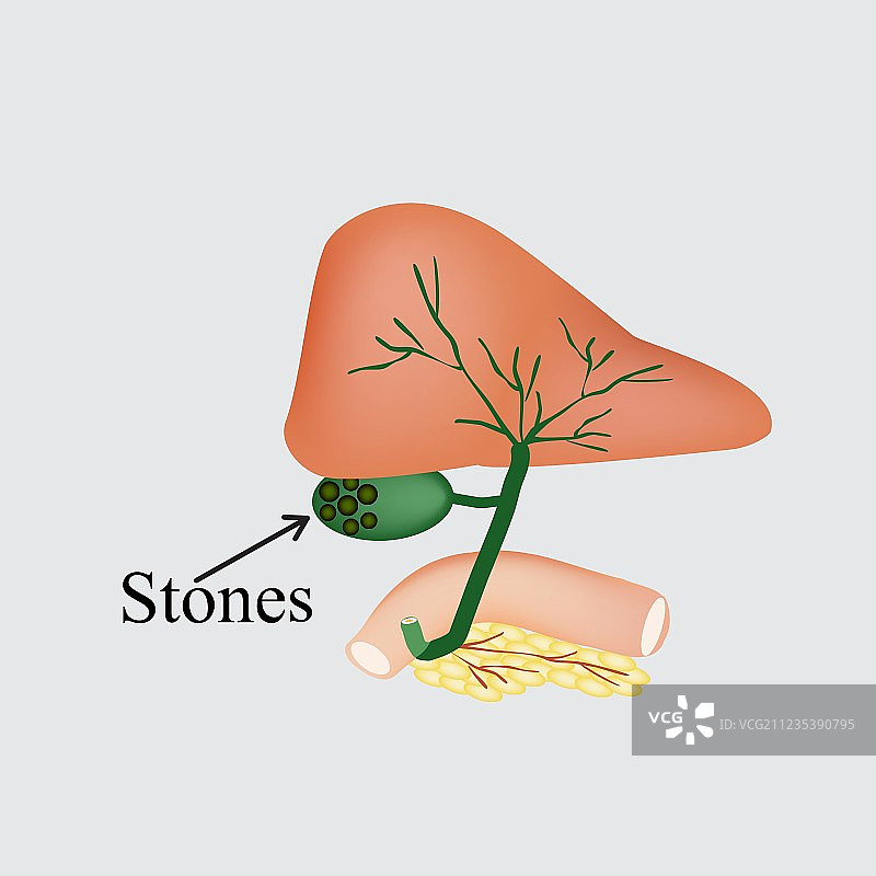 胆囊、十二指肠、胰腺中的结石图片素材
