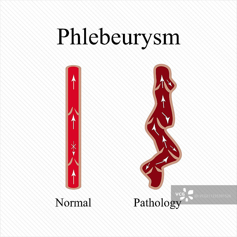 静脉曲张静脉疾病图片素材
