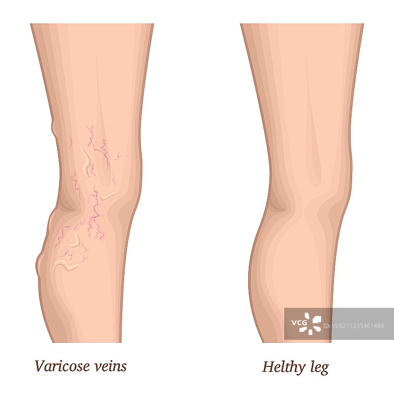 静脉曲张图片素材