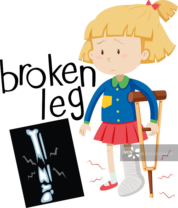 腿部骨折的女孩和X光片图片素材