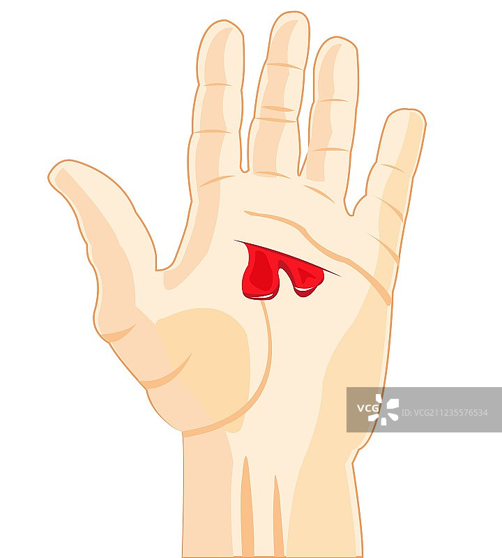 手部伤口图片素材