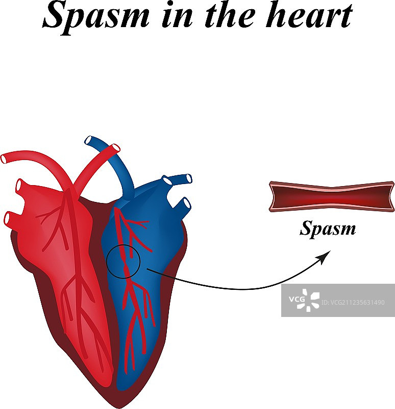 心脏动脉痉挛信息图图片素材