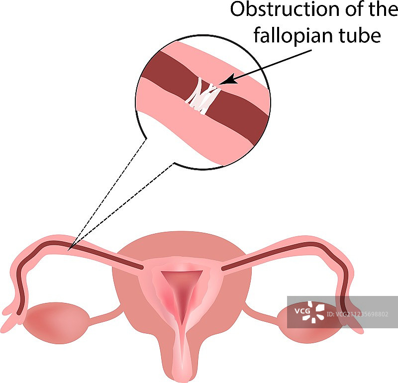 输卵管阻塞结构图片素材
