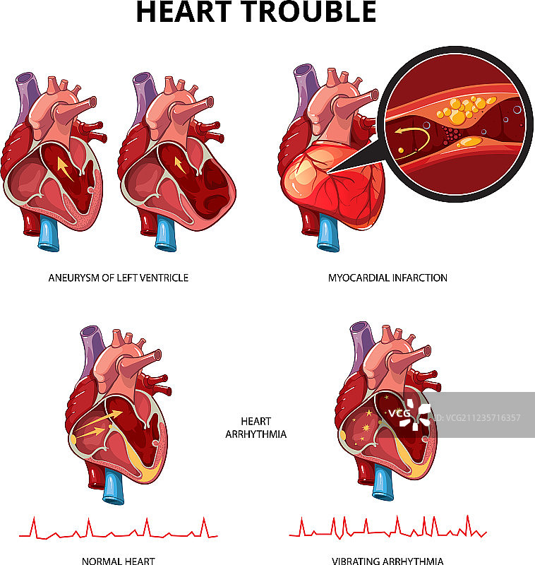 心脏病信息图图片素材