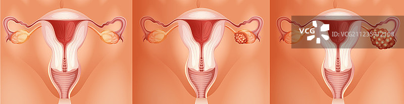 卵巢癌的三个阶段图片素材