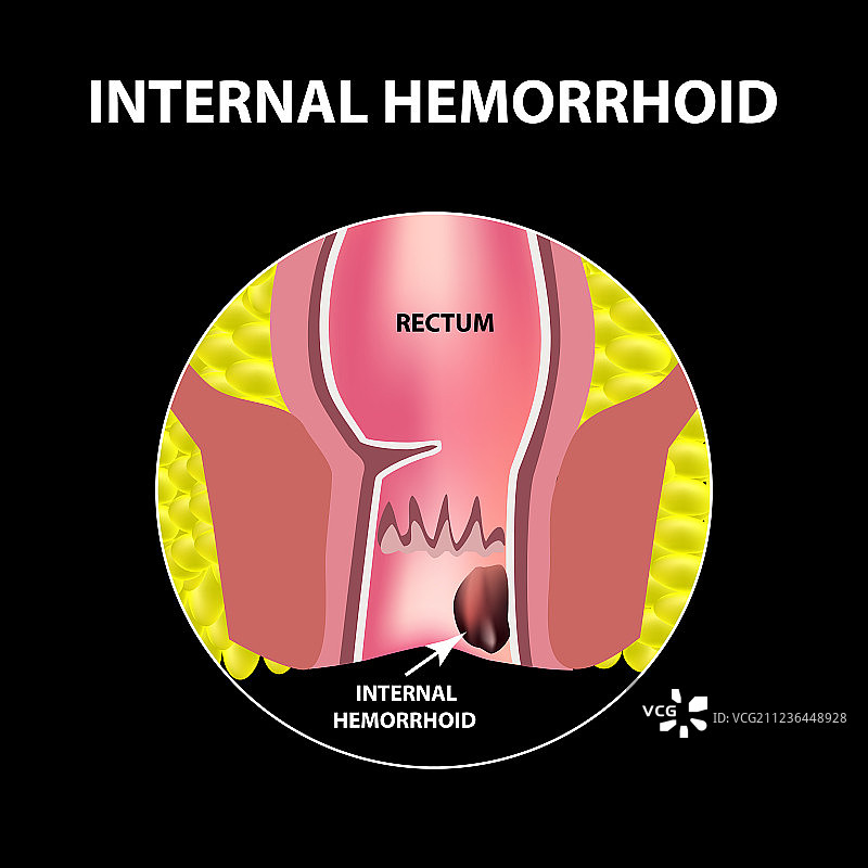 痔疮内直肠结构肠道图片素材