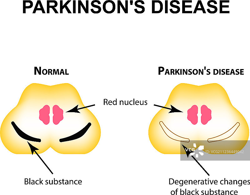 帕金森病的退行性改变图片素材