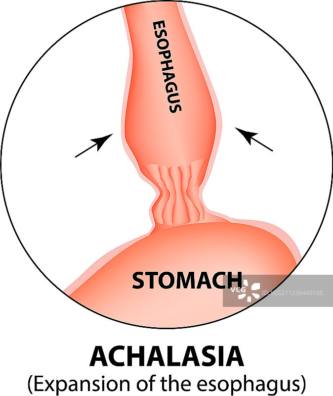 食管贲门失弛缓症图片素材