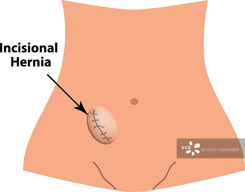 切口疝肠疝气信息图图片素材