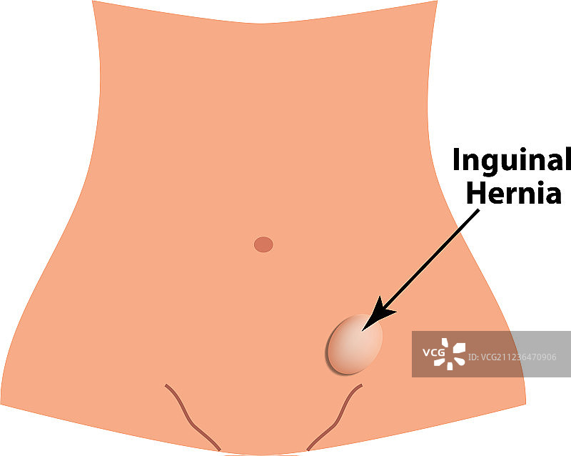 腹股沟疝气肠疝图片素材