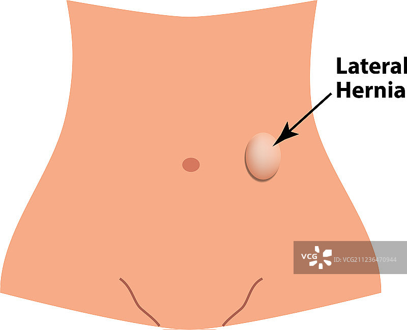 侧向疝肠疝图片素材