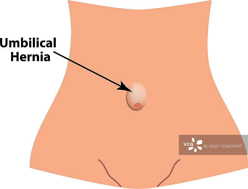 脐疝肠疝图片素材