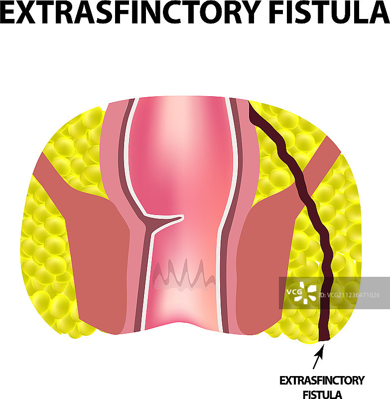 直肠肛瘘类型图片素材