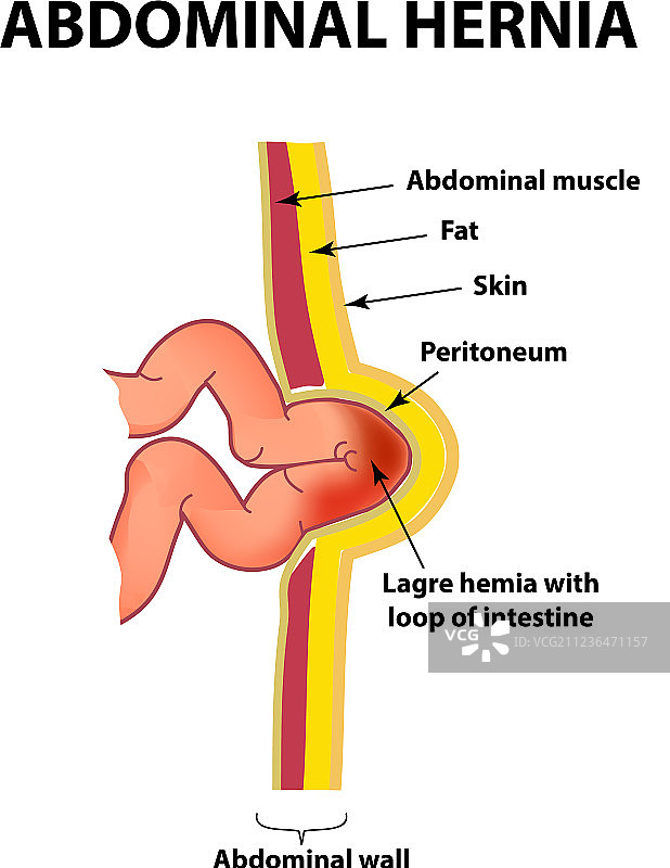 肠疝图信息图片素材