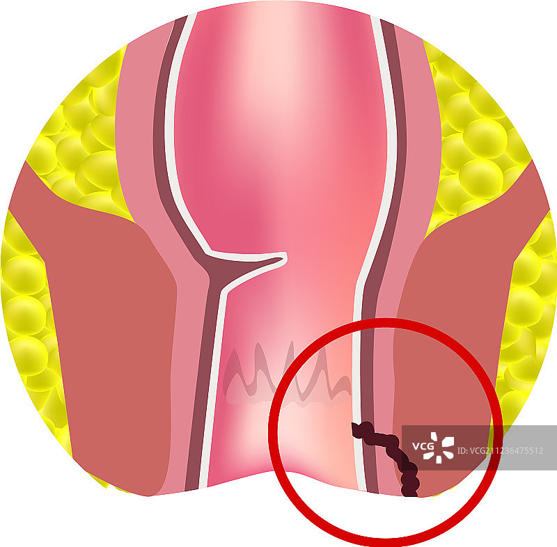 直肠肛瘘类型图片素材