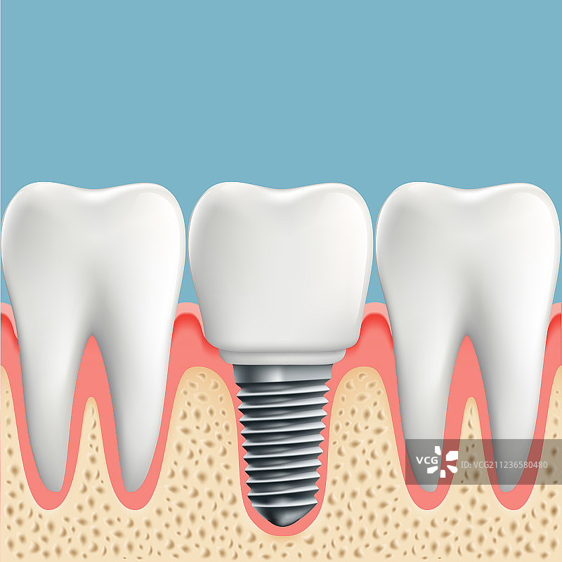 人的牙齿和牙科植入物图片素材
