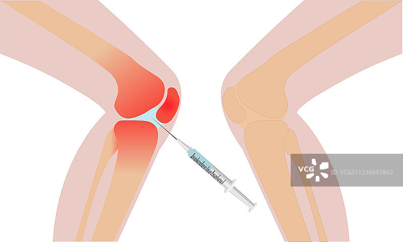 膝盖注射部位炎症红肿图片素材