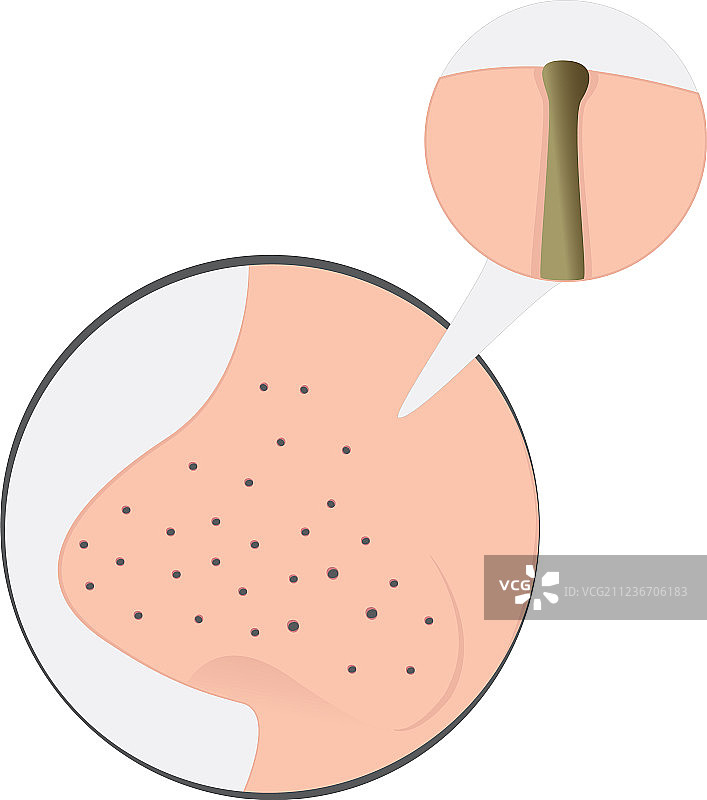 鼻子上的黑头图片素材