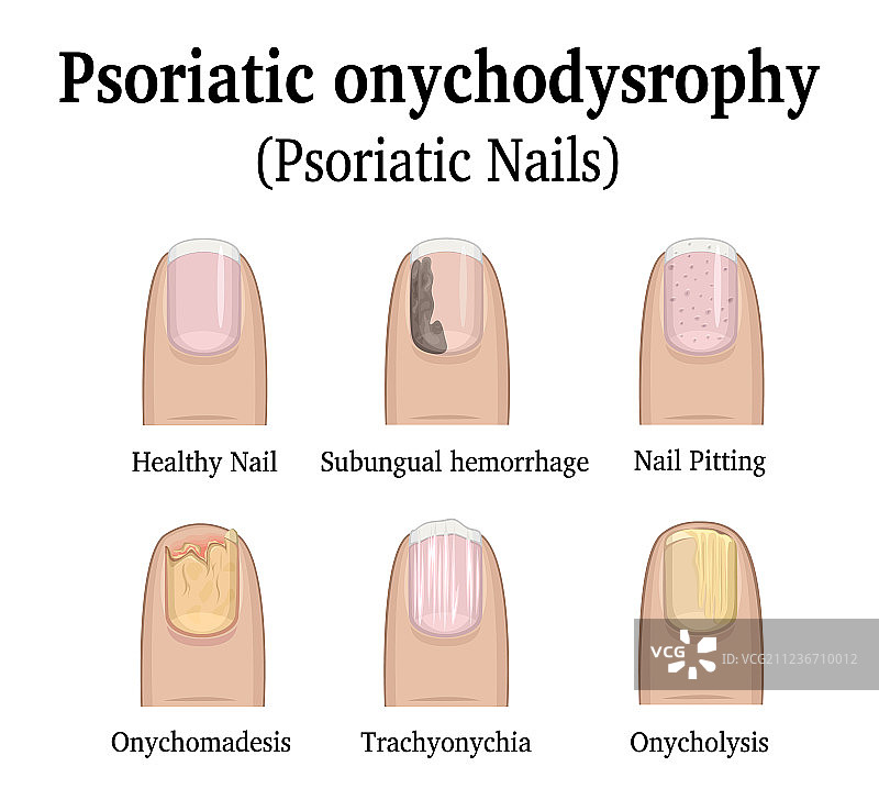 甲银屑病类型图片素材