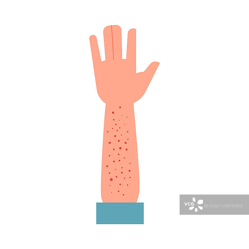 人类手部出现红色皮疹症状图片素材