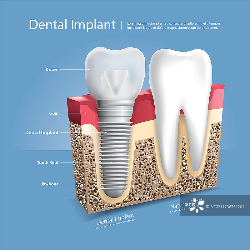 人的牙齿和牙科植入物图片素材